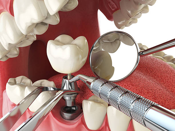 Best Emergency Wisdom Teeth Removal in Baldwin, MI